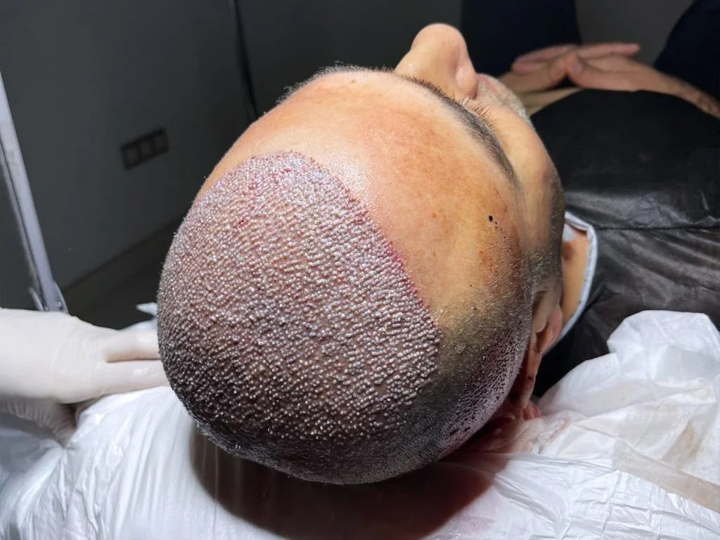FUE saç ekimi — greft yerleştirme sonrası klinik görüntü