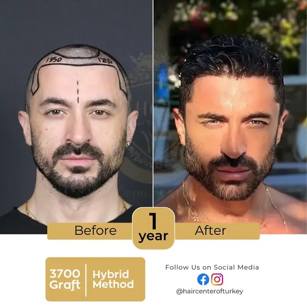 Hair Center of Turkey saç ekimi
