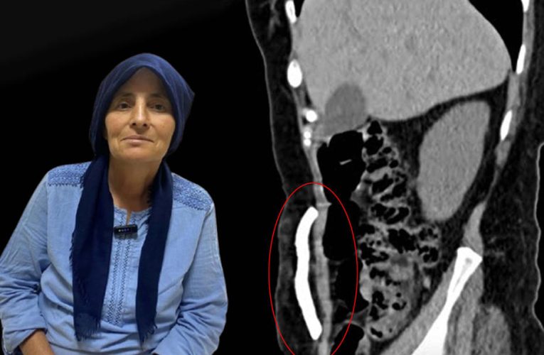 Manisa’da bir ilk. Karın boşluğunda aylarca kafatası kemiği taşıdı, sağlığına kavuştu