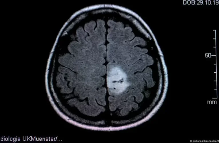 Glioblastoma tümörünün büyümesi ultrasonla canlı izlendi