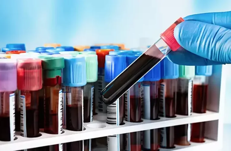 Pankreas kanserinde erken teşhis için yeni test geliştirildi